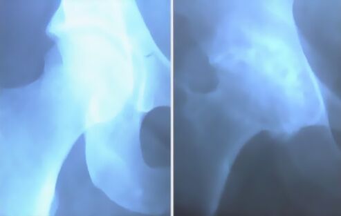 Остеоартритная мрака коленного сустава